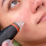 毛穴吸引器による内出血の原因とは？治し方や予防法・おすすめ機器も紹介